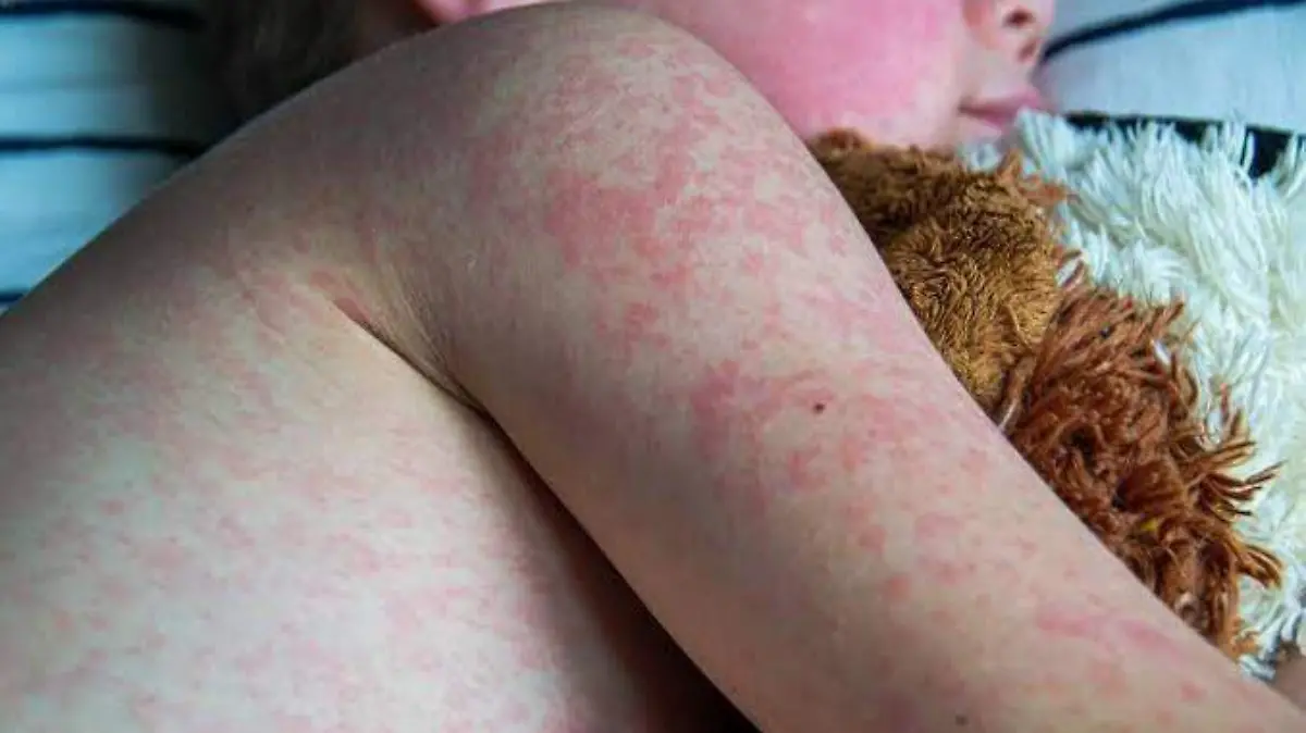 Confirman tres casos mas de sarampión en El Paso, Texas